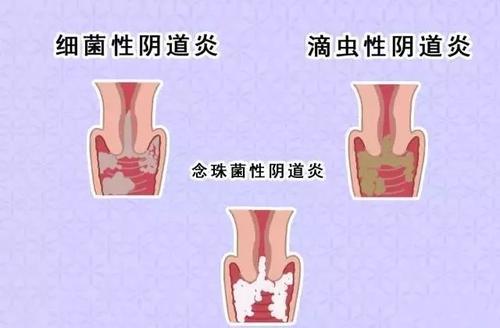 滴虫性阴炎症状